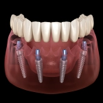 DENTAL AND IMPLANT ON THE SAME DAY